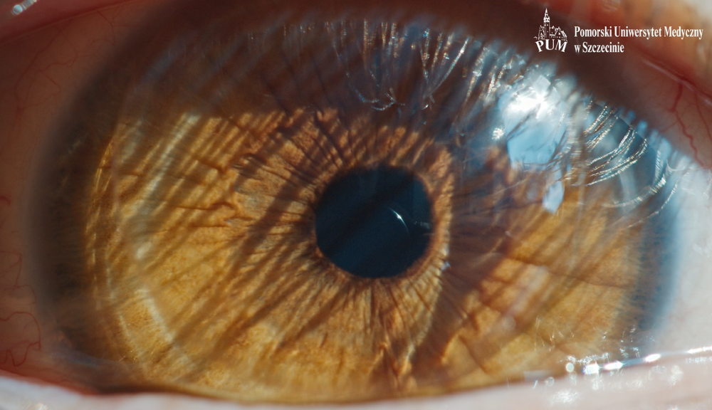 Weryfikacja zastosowania immunomodulującego działania podprogowej laseroterapii mikropulsowej w zwyrodnieniu barwnikowym siatkówki z próbą optymalizacji protokołów laserowania 577 nm i 810 nm