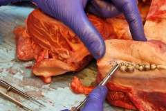 Minimalnie inwazyjne leczenie chirurgiczne